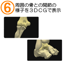 周囲の骨との関節の様子を3DCGで表示