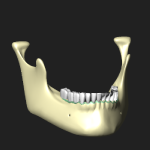 歯槽隆起（下顎骨）