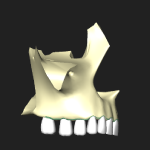 歯槽隆起（上顎骨）